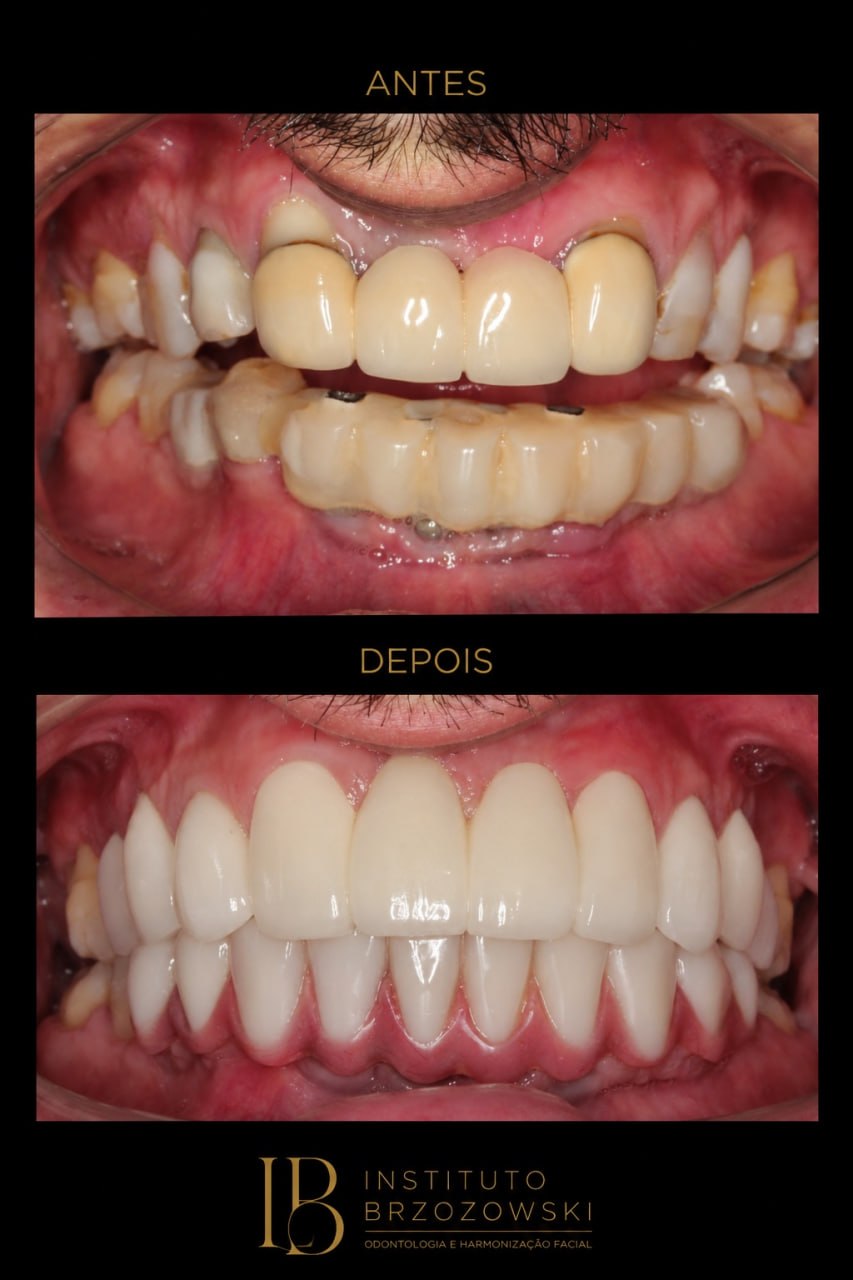 Antes e depois de caso de implantes dentarios realizado no Instituto Brzozowski